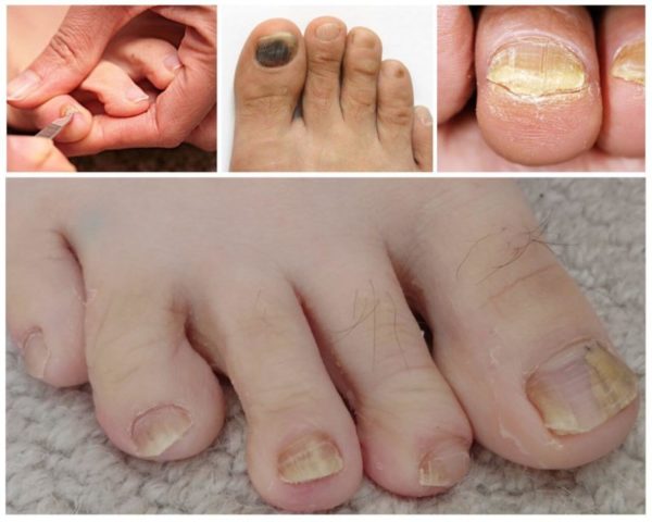 Какой врач лечит грибок ногтей на ногах: выбираем специалиста по онихомикозу
