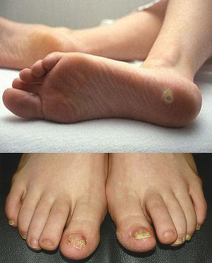 Грибок на ногах: как выглядит, виды патологии и степень поражения кожи, эффективные методы лечения2