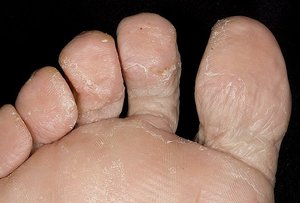 Грибок на ногах: как выглядит, виды патологии и степень поражения кожи, эффективные методы лечения7