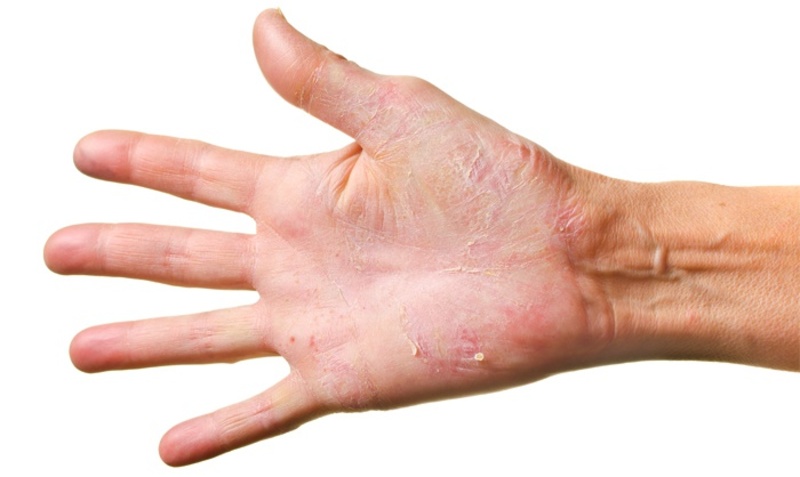 Грибок на пальцах рук: симптомы заболевания, диагностика, применение мазей при лечении микоза9