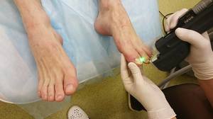 Грибок на ногах: как выглядит, виды патологии и степень поражения кожи, эффективные методы лечения8