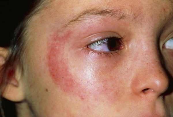 Аллергический дерматит: причины развития, симптомы, диагностика, терапия 3
