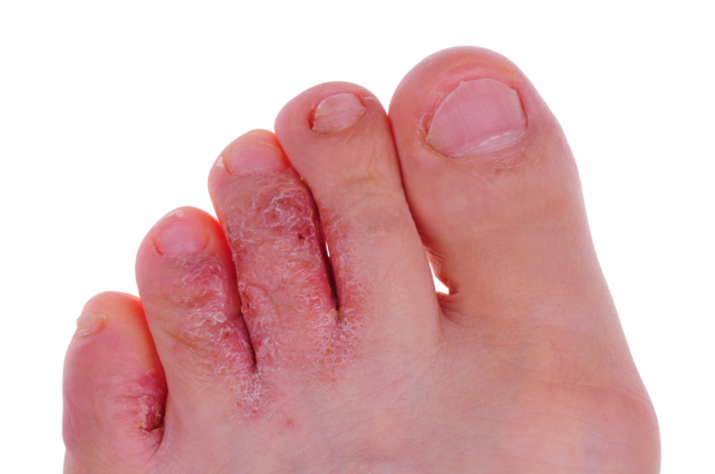 Грибок ног: как выглядит, виды патологии и степень поражения кожи, эффективные методы лечения3