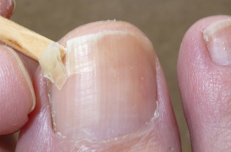 Грибок ногтей на ногах: народные средства, чтобы быстро избавиться от него в домашних условиях