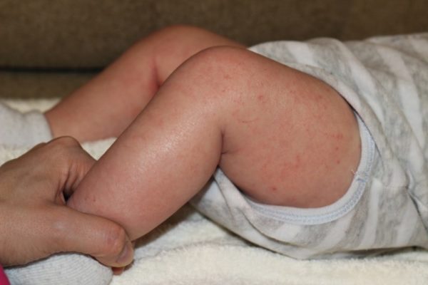 Атопический дерматит у детей: факторы риска, симптомы, диагностика, терапия 13
