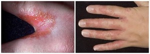Грибок на пальцах рук: симптомы заболевания, диагностика, применение мазей при лечении микоза4
