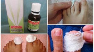 Средство от грибка ногтей на руках: эффективные противогрибковые таблетки и капли, мази и кремы