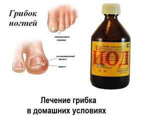 Лечение грибка ногтей йодом: симптомы, народные методы лечения онихомикоза ногтевой пластины на стопах4