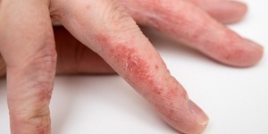 Лечение грибка рук: признаки и симптомы кожных заболеваний, методы лечения 2