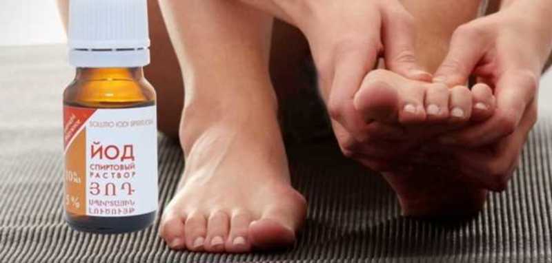 Лечение грибка ногтей йодом: симптомы, народные методы лечения онихомикоза ногтевой пластины на стопах5