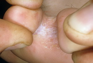 Грибок между пальцами: симптомы и признаки, лечение препаратами и народными средствами7