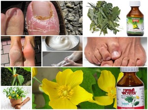 Чистотел от грибка ногтей на ногах: описание и свойства, лечение масляными и фармацевтическими препаратами, отзывы