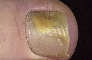 Масло от грибка ногтей: действие, особенности использования натурального противогрибкового средства