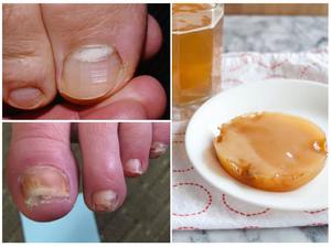 Грибок ногтей на ногах: народные средства, чтобы быстро избавиться от него в домашних условиях