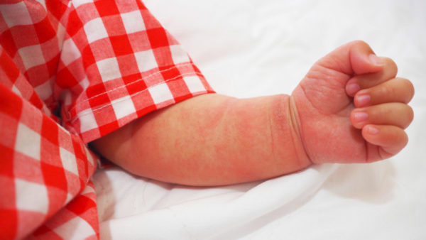 Атопический дерматит у младенцев на грудном вскармливании: как распознать и как лечить