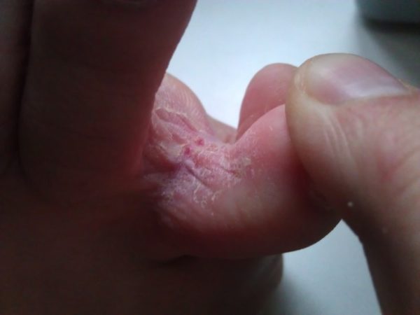 Грибок между пальцами: признаки, причины развития, профилактика, медикаментозная терапия