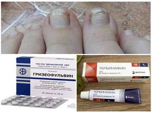 Противогрибковые препараты для ногтей на ногах: типы препаратов и эффективность лечения грибков 4