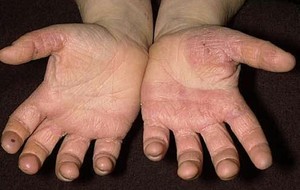 Лечение грибка рук: признаки и симптомы кожных заболеваний, методы лечения8