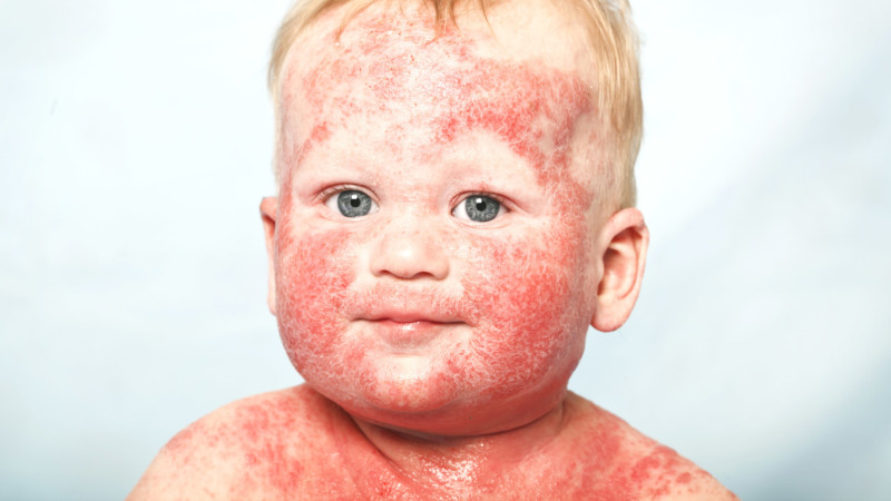 Alergia kiwi bebe