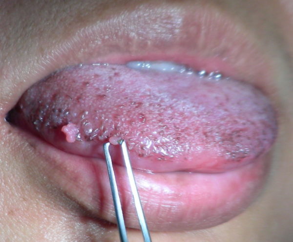 Папиллома во рту: что это такое, причины болезни и лечение