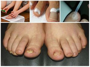 Лечение грибка ногтей йодом: симптомы, народные методы лечения онихомикоза ногтевой пластины на стопах