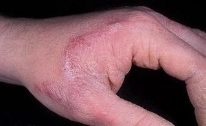 Лечение грибка рук: признаки и симптомы кожных заболеваний, методы лечения 4