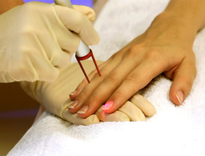 Грибок на пальцах рук: симптомы болезни, диагностика, применение мазей при лечении микоза