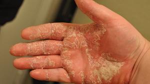 Лечение грибка рук: признаки и симптомы кожных заболеваний, методы лечения