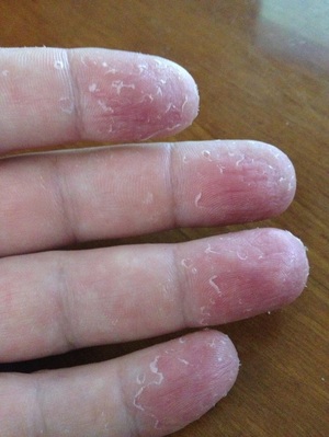 Грибок на пальцах рук: симптомы болезни, диагностика, применение мазей при лечении микоза