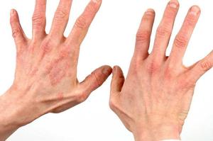 Лечение грибка рук: признаки и симптомы кожных заболеваний, методы лечения9