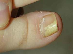 Аммиак от грибка ногтей: рецепты на основе аммиака лечения грибка на ногах